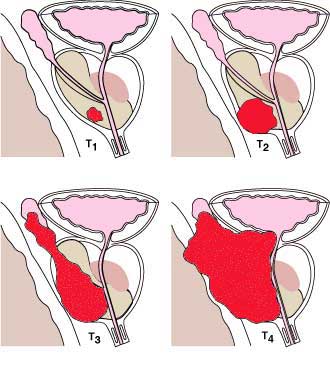 Tumore prostatico